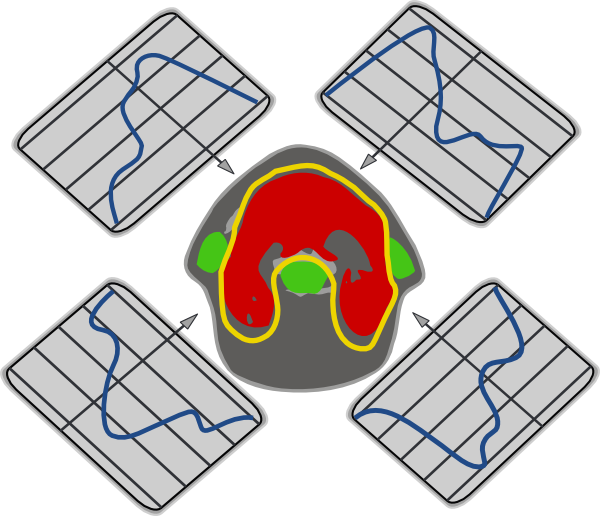 Clipart Info - Imrt (600x516), Png Download