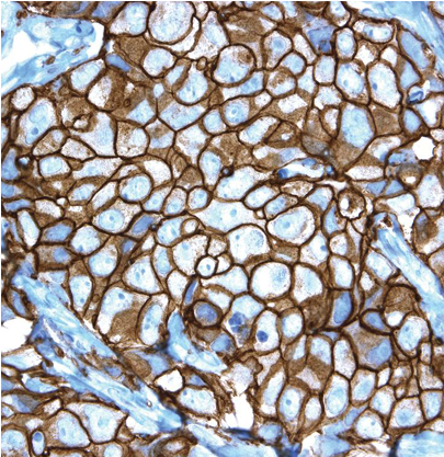 Pathway® Her-2/neu Rabbit Monoclonal Primary Antibody - Stained Glass (740x416), Png Download