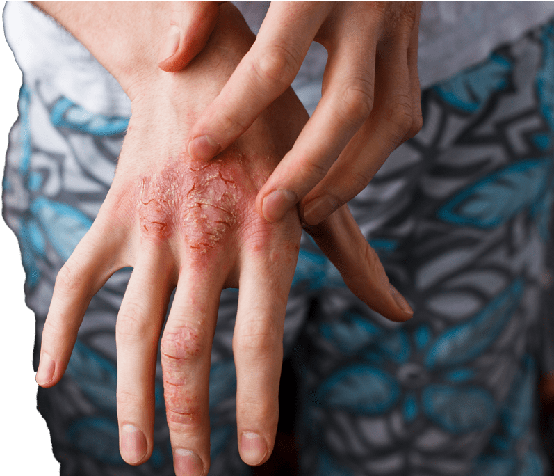 Facial Redness, Rosacea & Spider Veins - Human (1024x683), Png Download