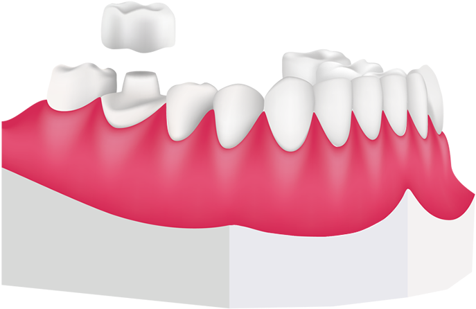 Dental Crowns At Toothbeary (700x471), Png Download