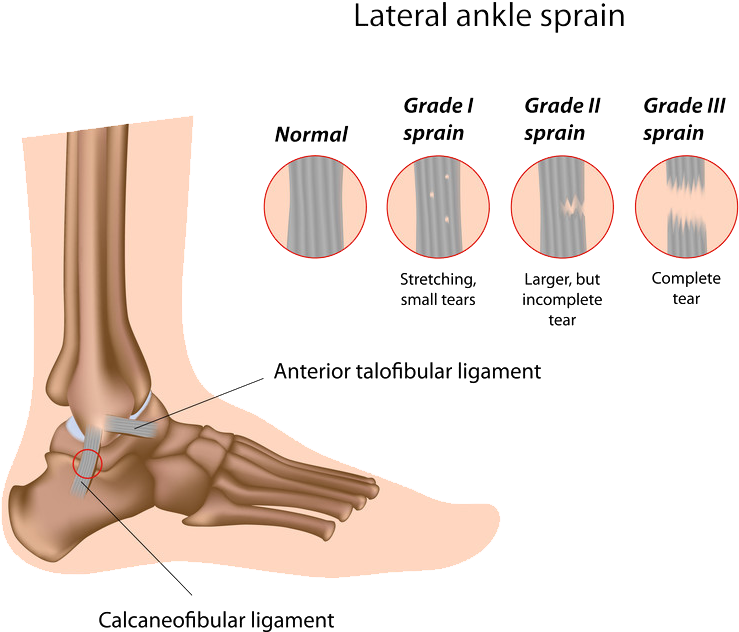 Surgical Options - Sprained Ankle Grade 2 (800x671), Png Download