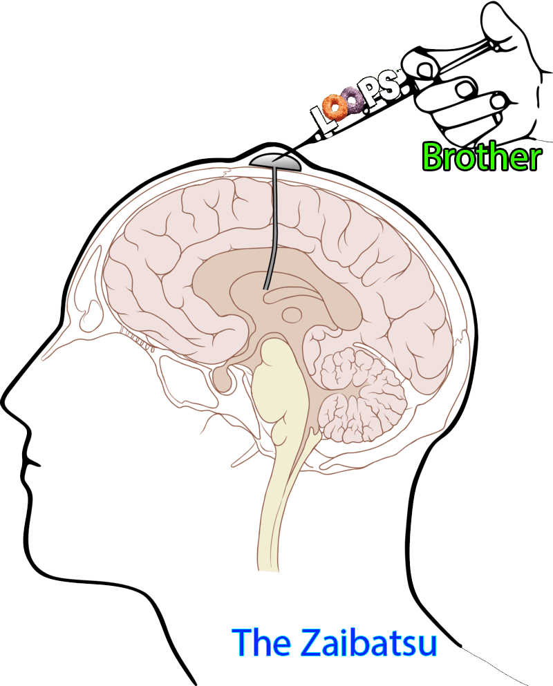 The Absolute State Of Things - Ommaya Reservoir (800x993), Png Download