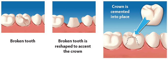Crowns - Crown Placement On Tooth (700x255), Png Download